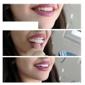 Licówki dentystyczne Snap on Smile 1 sztuka (zestaw góra i dół)